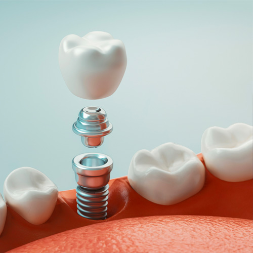 Dantų implantavimas | Odontologijos klinika Šiauliuose